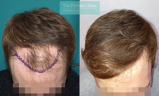 FUE Hair Transplant - 034MM - Front