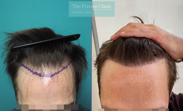 FUE Hair Transplant - 035MM - Front