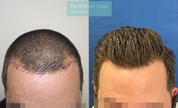 FUE Hair Transplant - 036MM - Front