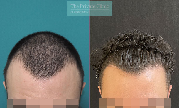 FUE Hair Transplant - 037MM - Front