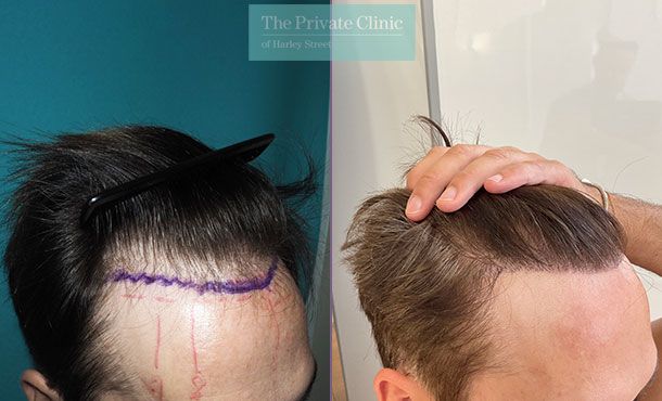FUE Hair Transplant - 035MM - Side