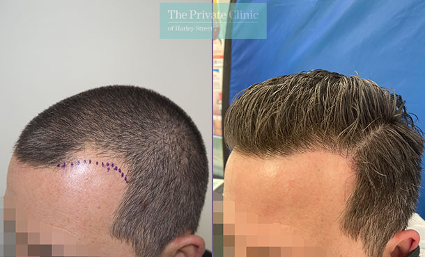 FUE Hair Transplant - 036MM - Side