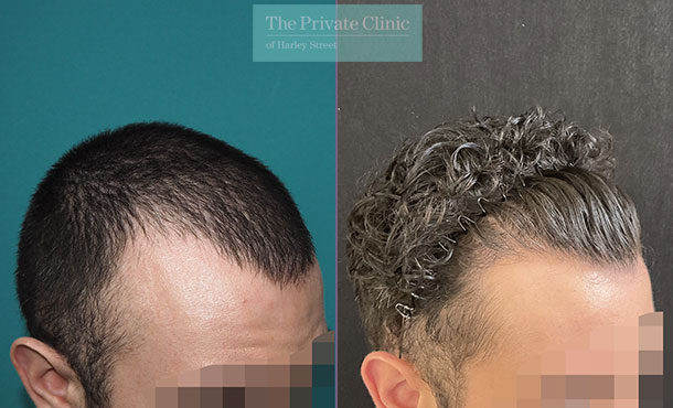 FUE Hair Transplant - 037MM - Side