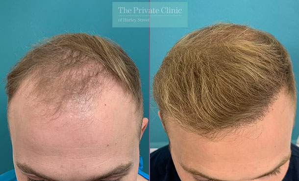 FUE Hair Transplant - 022FR - Front