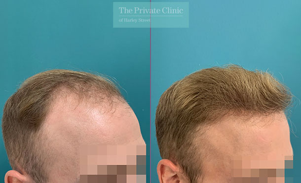 FUE Hair Transplant - 022FR - RSide