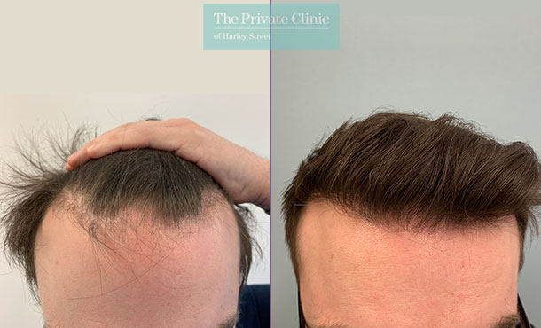 Hair Transplant - Front 021FR