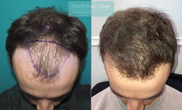 Hair Transplant - 033MM - Front