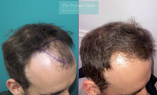 Hair Transplant - 033MM - Side