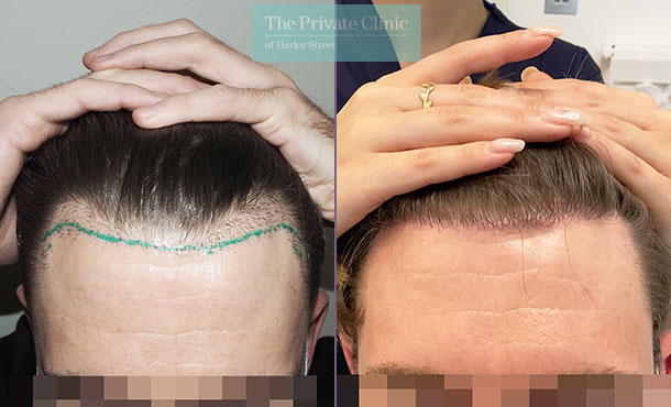 FUE Hair Transplant Repair - 032MM - Front - The Private Clinic of Harley  Street