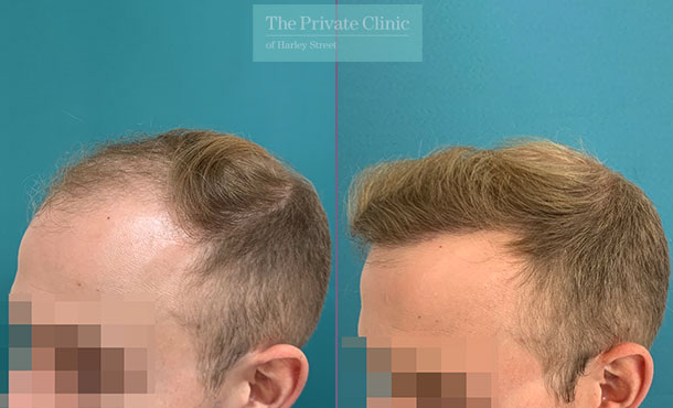 Calum Best  Hair Transplant Case Study  Crown Clinic