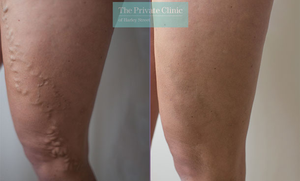 varicose veins upper leg before after photo