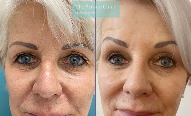 Blepharoplasty before and after photos natural results