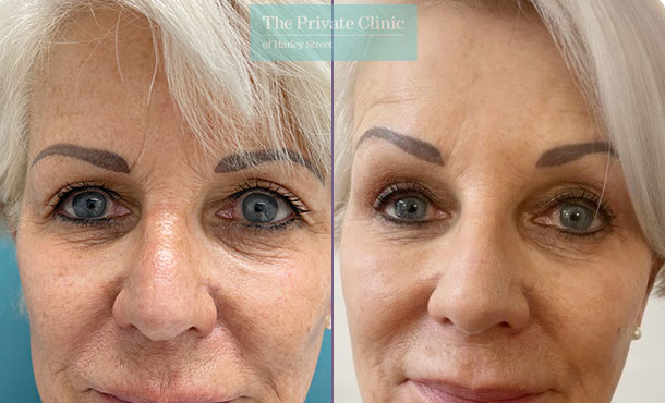 Blepharoplasty procedure before and after photo natural results