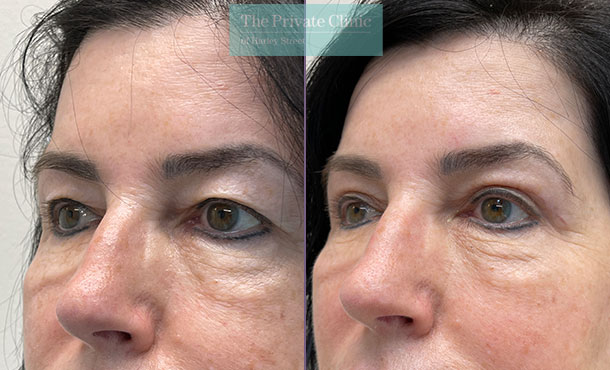 Blepharoplasty - 022DF-Side