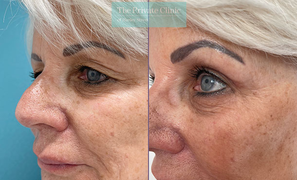 Blepharoplasty Eyelid Lift Surgery before and after photo