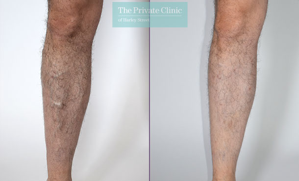 varicose veins leg for men removal before after photo