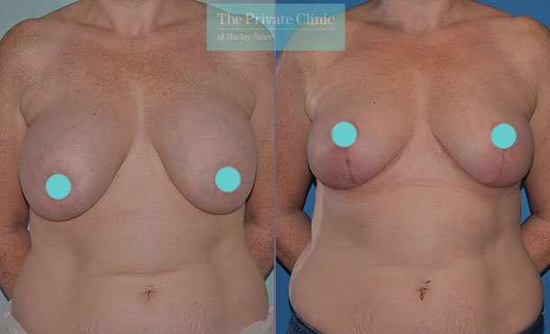 Breast Auto Augmentation northampton before after photo