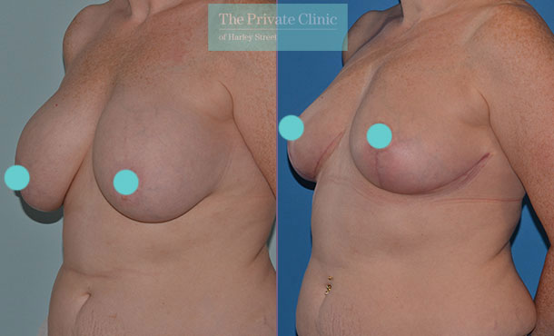 natural breast augmentation before after photo