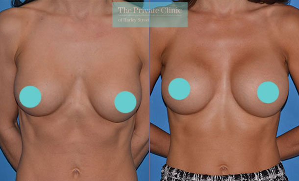 breast implants replacement before after photo