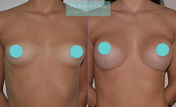 Before and after Breast Enlargement at The Private Clinic.