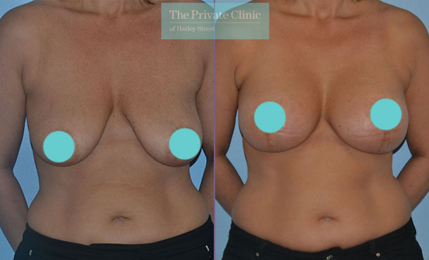 Before and after Breast Uplift at The Private Clinic.