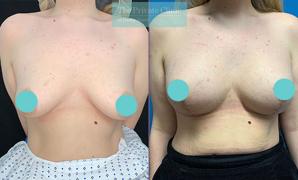 Before and after Breast Uplift with Implants at The Private Clinic.