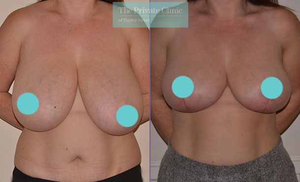 Before and after Breast Reduction at The Private Clinic.