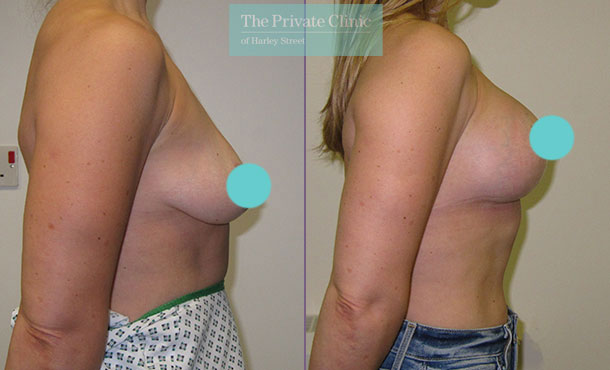 Before and after Breast Uplift at The Private Clinic.