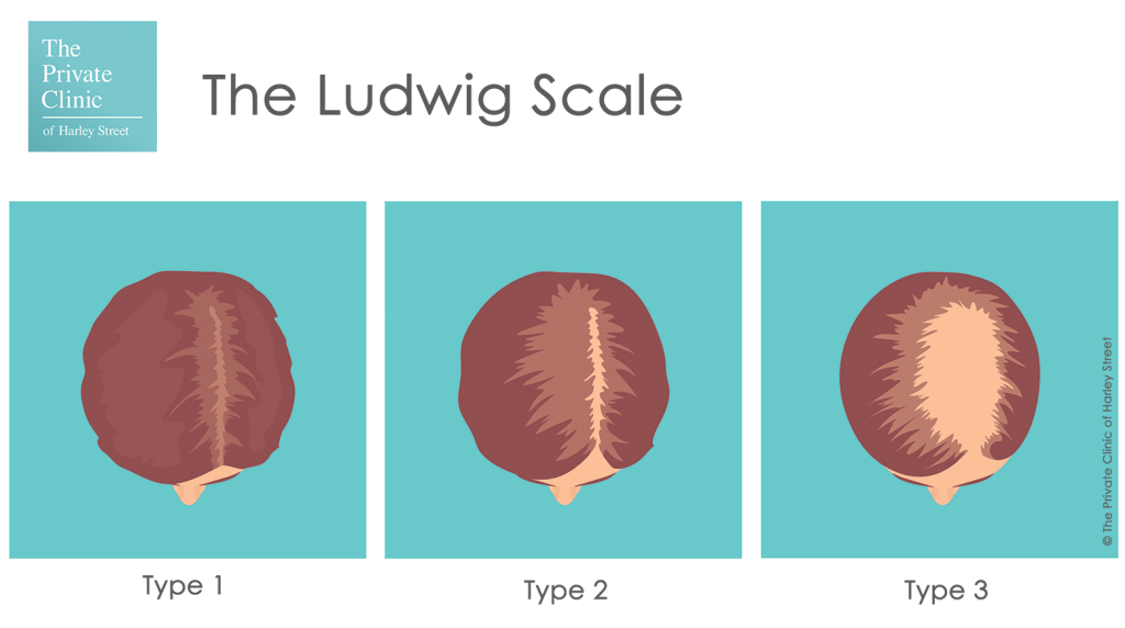 ludwig-scale-female-pattern-hair-loss