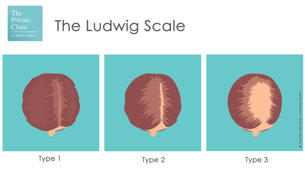 Ludwig's Scale for Women - Use Ludwigs Scale Chart For Hair Loss