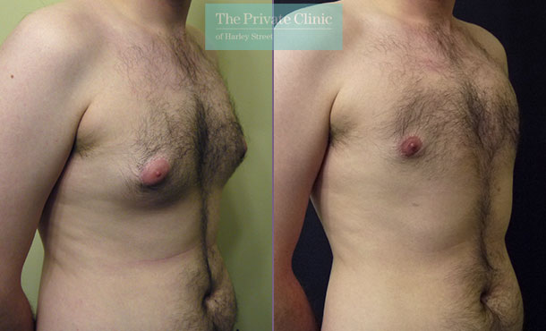 Male Chest Reduction northampton before after photo