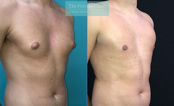 gynaecomastia before after photo