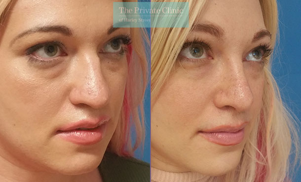 Rhinoplasty nose job before after photo