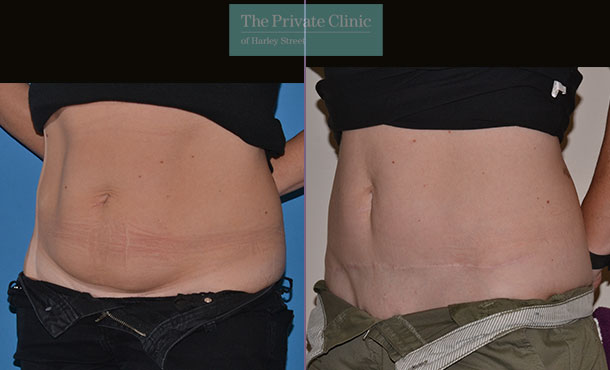 Abdominoplasty surgery before after photo