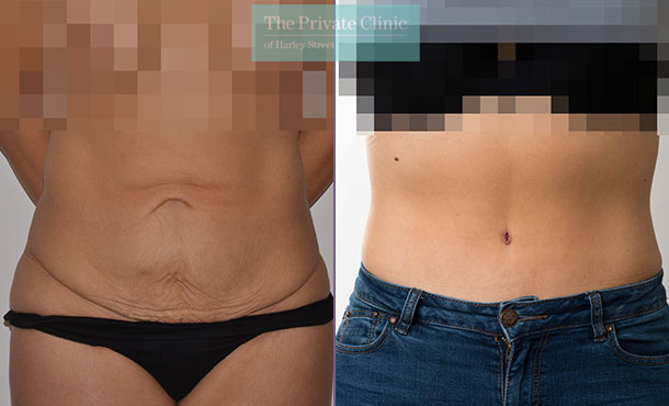 Tummy Tuck before and after photos