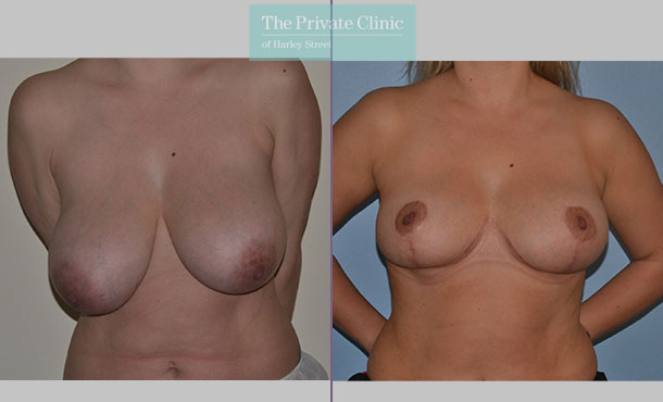 Breast Reduction - 074AR-R - Front