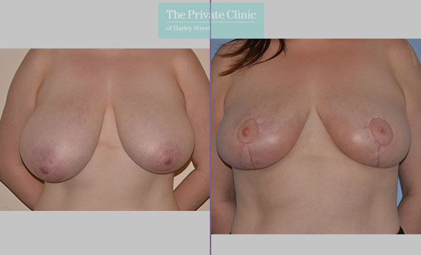 Breast Reduction - 077AR-R - Front