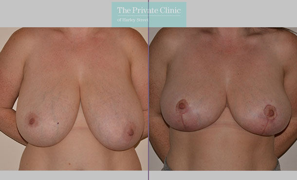 Breast Reduction - 078AR-R - Front