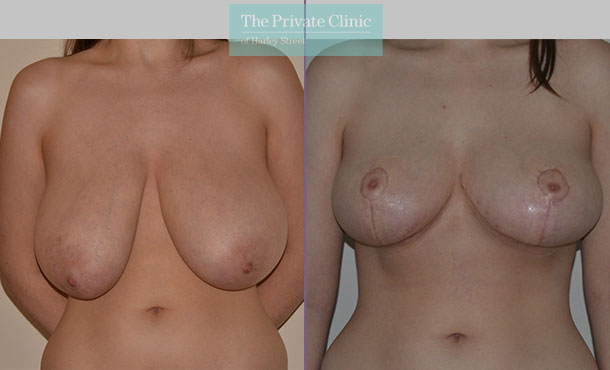 Breast Reduction - 079AR-R - Front