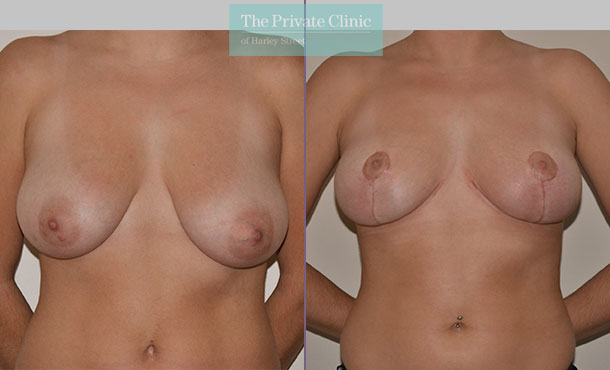 Breast Reduction - 081AR-R - Front