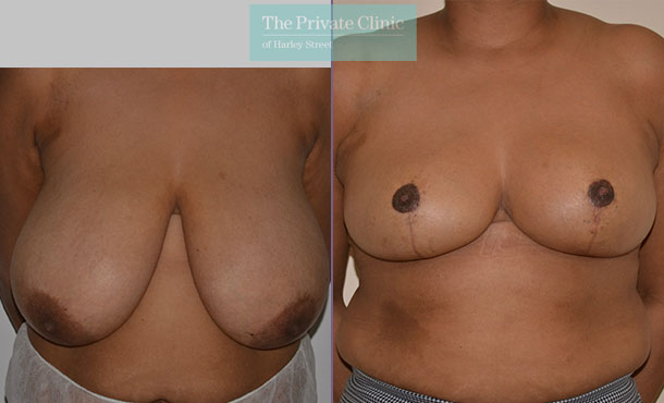 Breast Reduction - 083AR-R - Front