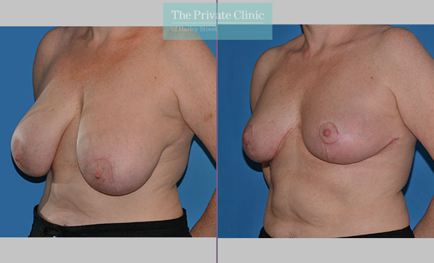 Breast Reduction - 071AR-R - Side