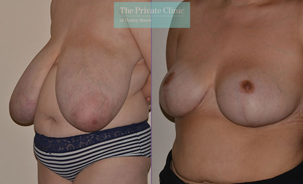 Breast Reduction - 073AR-R - Side