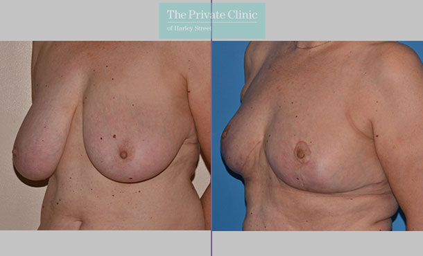 Breast Reduction - 075AR-R - Angle