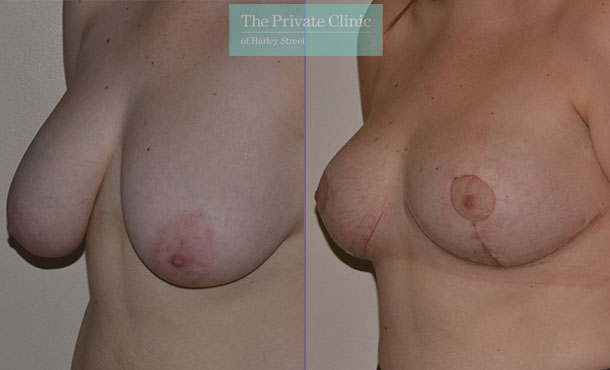 Breast Reduction - 076AR-R - Angle