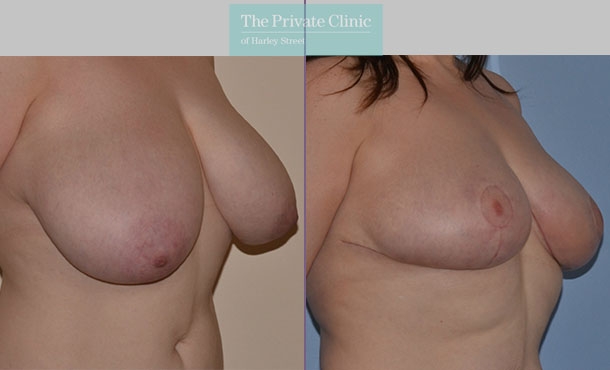 Breast Reduction - 077AR-R - Angle