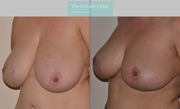 Breast Reduction - 078AR-R - Angle