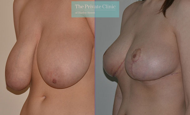 Breast Reduction - 079AR-R - Angle