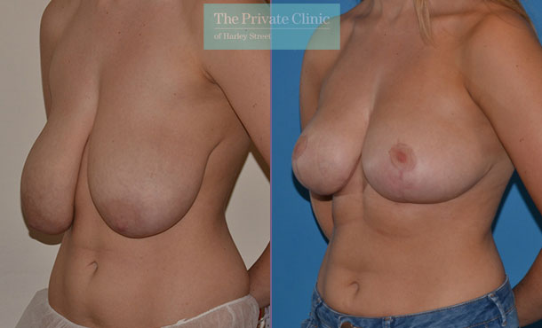 Breast Reduction - 080AR-R - Angle