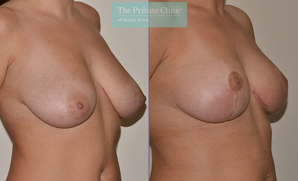 Breast Reduction - 081AR-R - Side